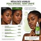 ANUA Azelaic Acid 10 Hyaluron Redness Soothing Serum – Sérum Apaisant Anti-Rougeurs